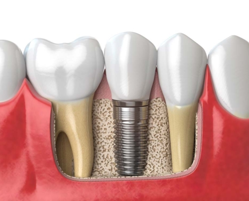 IMPLANTS DENTALS