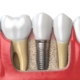 IMPLANTS DENTALS